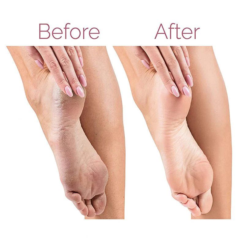 Electric Pedicure Foot File & Callus Remover — Rechargeable 2-Speed Foot Care Device